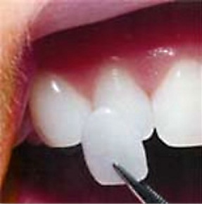 A single porcelain veneer being placed on a tooth.