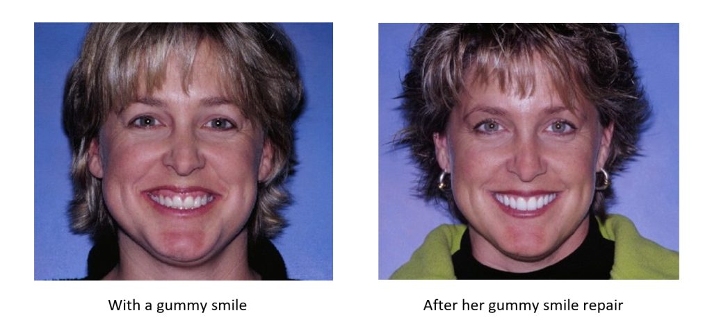 Before and after the repair for a gummy smile